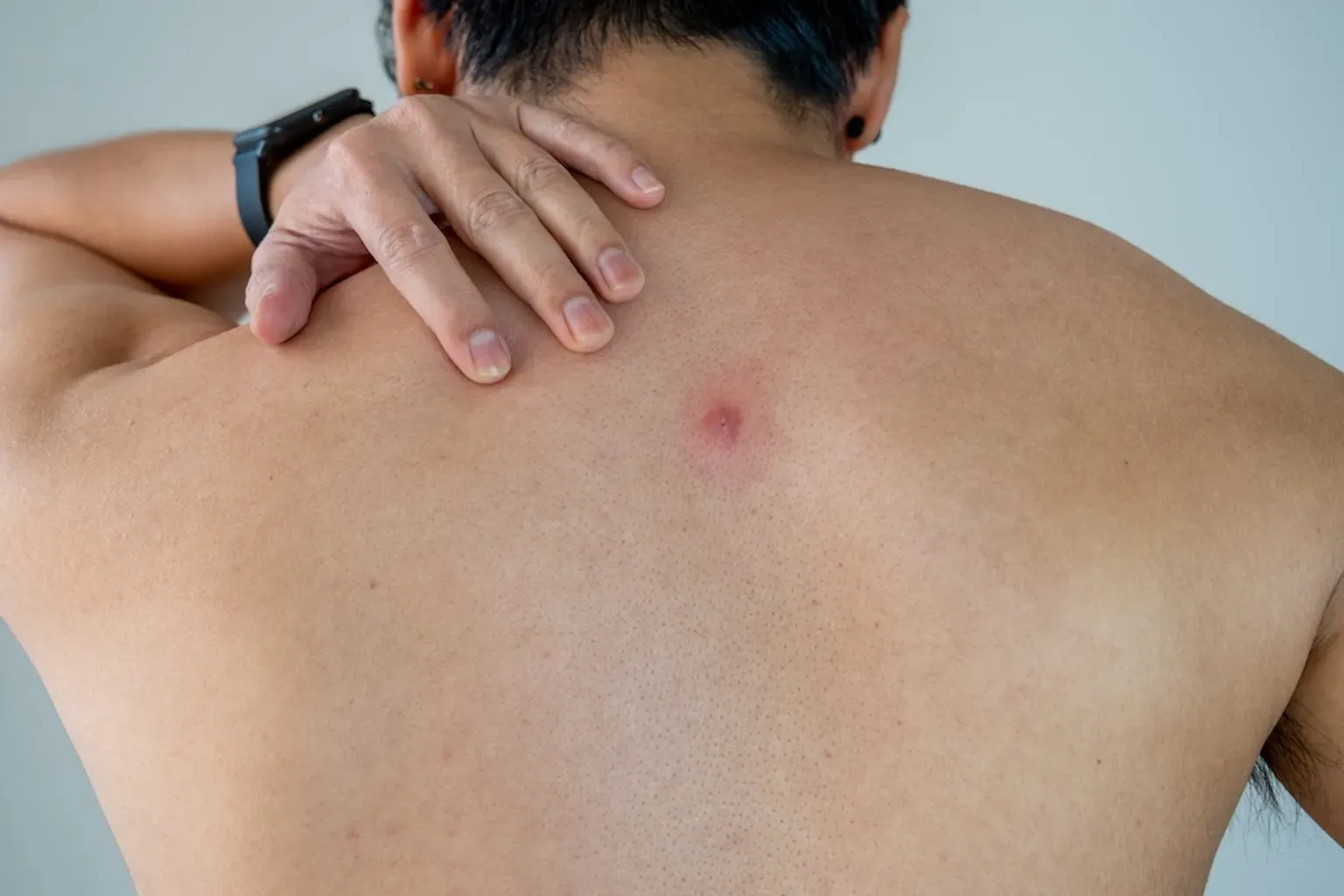 Abscess